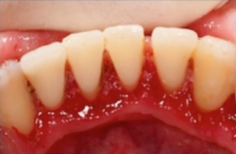 Danger Zone! 5 Signs Of Gum Disease