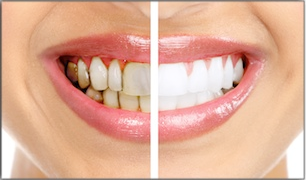 Whitening For 3 Types Of Tooth Stains