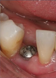 Implants At Falls Pointe Dental