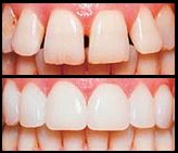 teeth with veneers and without veneers